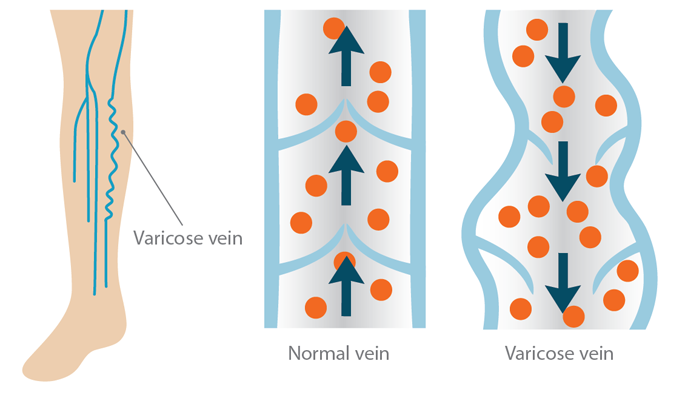 how do varicose veins form dolap magnetband co what is a vein and how does it form
